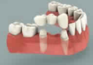soins dentaires etranger bridge