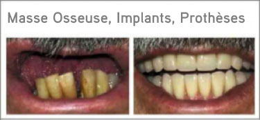 jacky-teeth-with-treatment-name