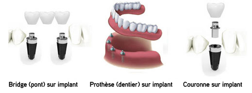 Prix implants dentaires