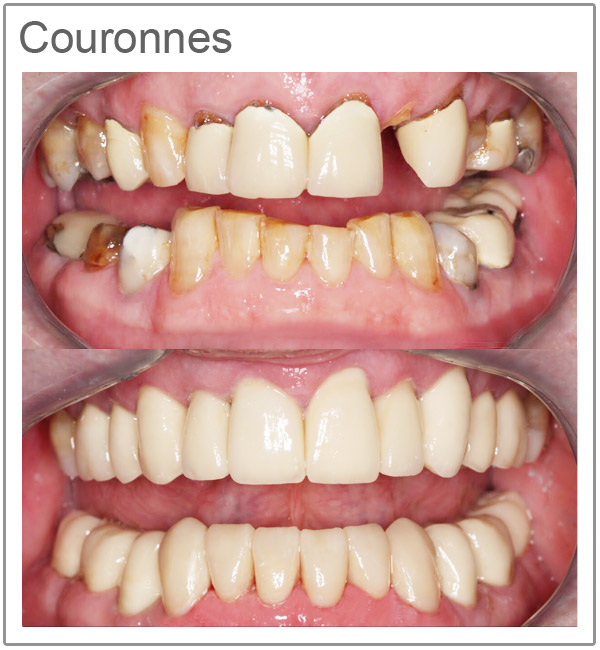 Couronne provisoire – types, matériaux, durée et prix