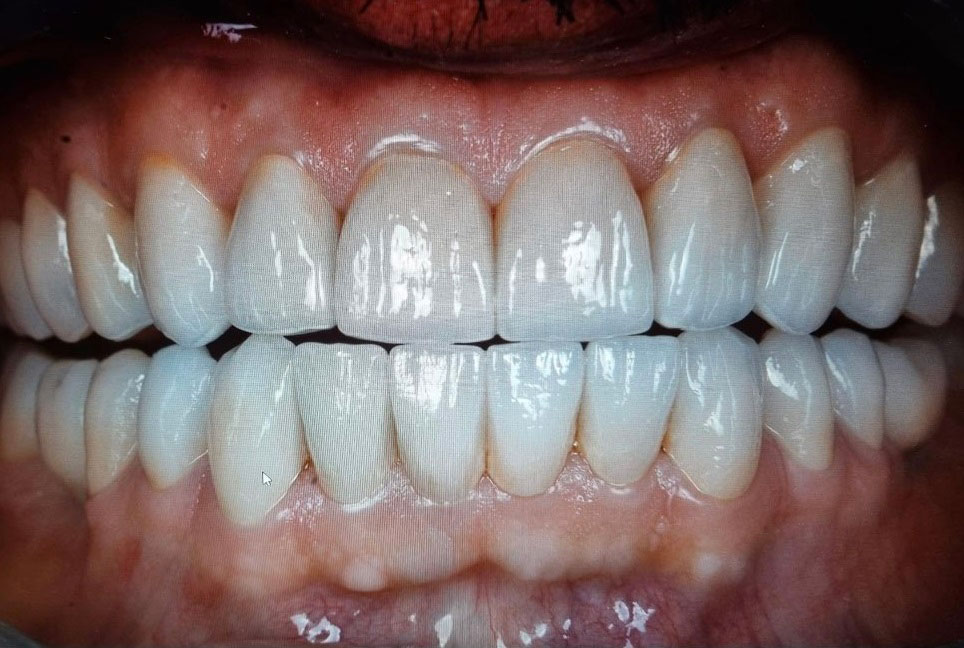 prix implants dentaires chez helvetic clinics 