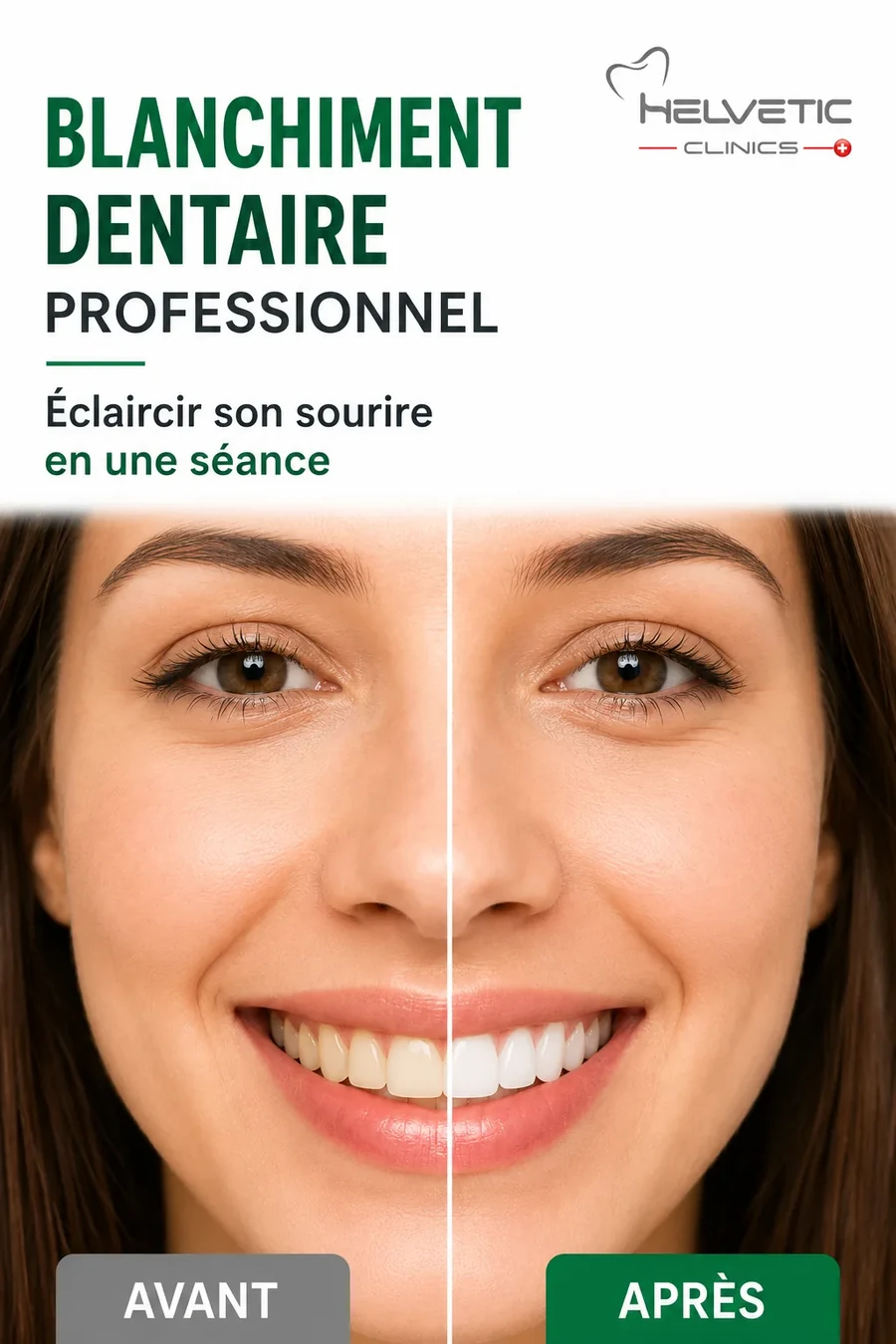 blanchiment dentaire professionnel avant apres helvetic clinics budapest