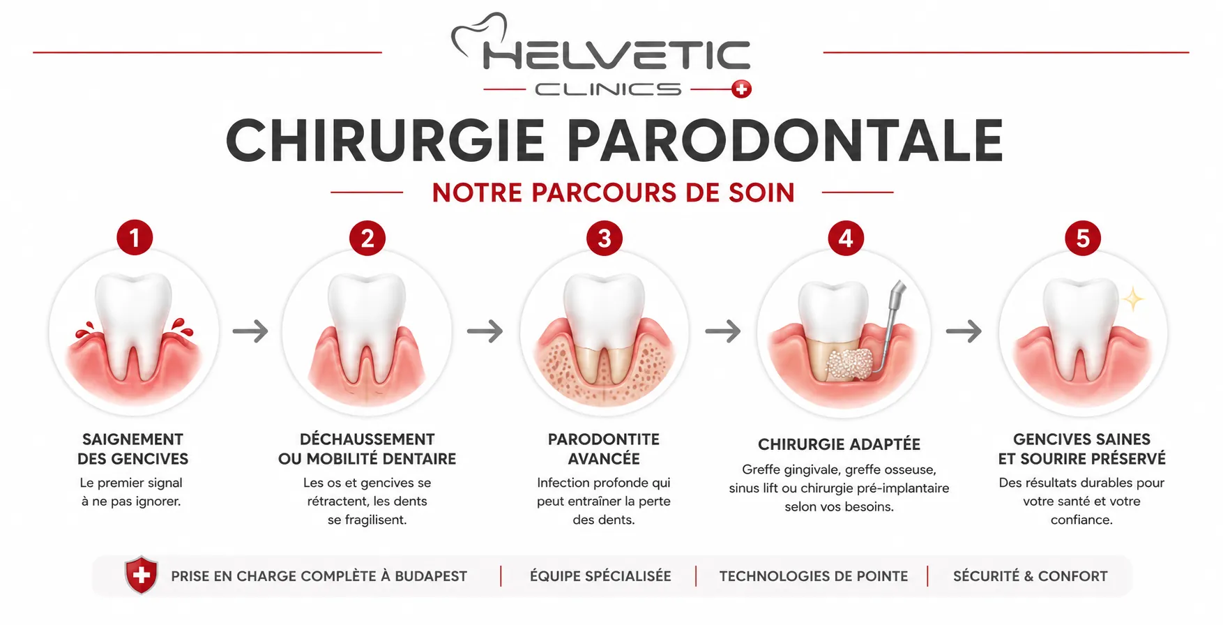 Schéma illustrant l'évolution de la maladie parodontale et les solutions proposées par Helvetic Clinics Budapest : saignement des gencives, déchaussement, parodontite avancée, chirurgie parodontale et sourire préservé.