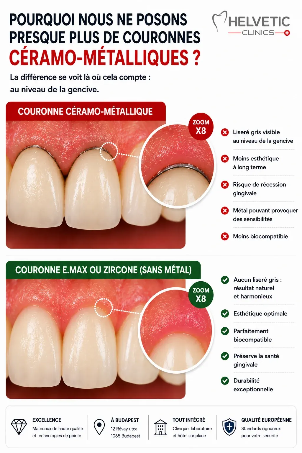 Comparatif des couronnes dentaires E.max, zircone et céramo-métal chez Helvetic Clinics Budapest : différences esthétiques, résistance, indications et avantages de chaque matériau.