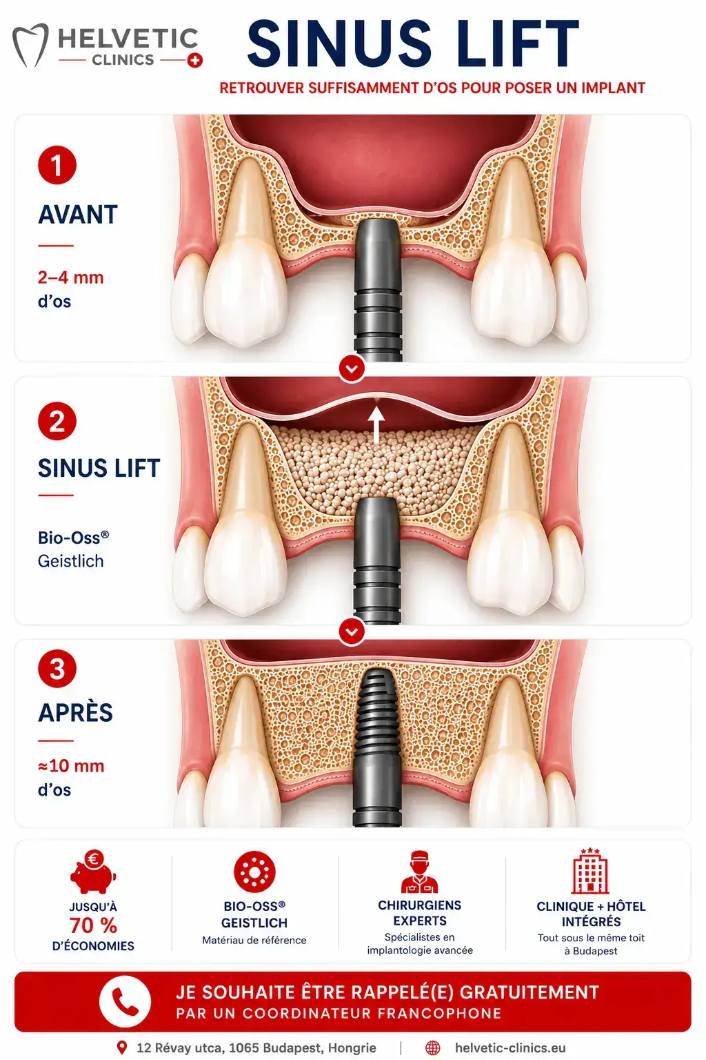 Schéma médical illustrant les trois étapes d'un sinus lift avant la pose d'un implant dentaire chez Helvetic Clinics en Hongrie.